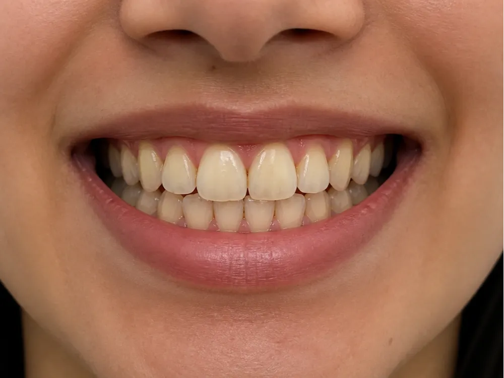 Before whitening