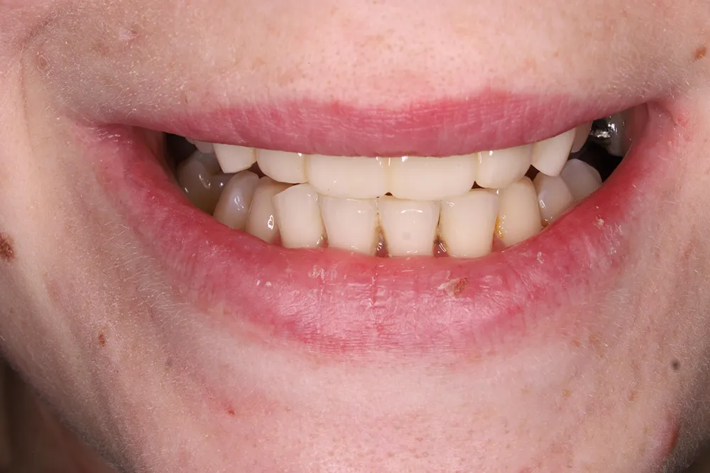 After dental bridge