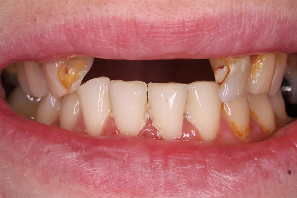 Before dental bridge