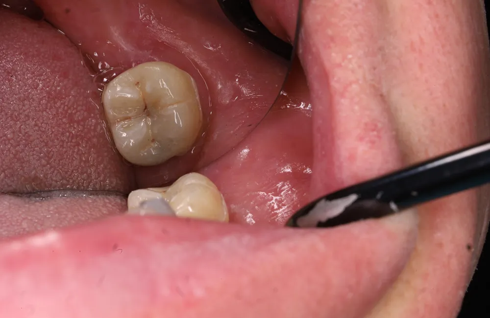 After ceramic overlay