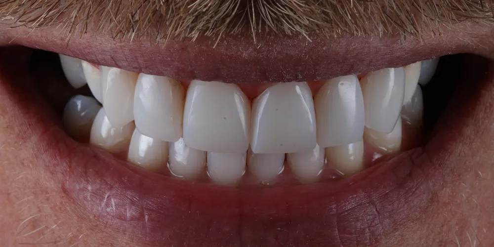 After Composite Bonding