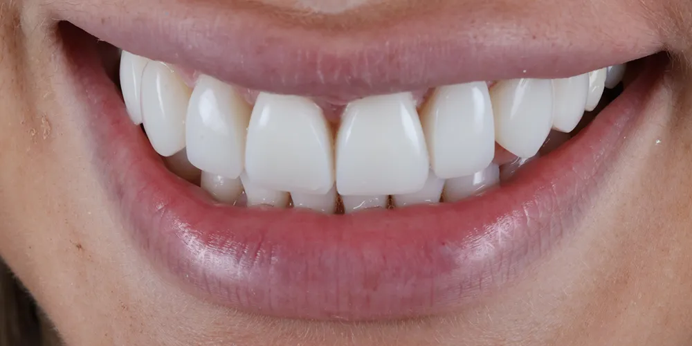 After Composite Bonding