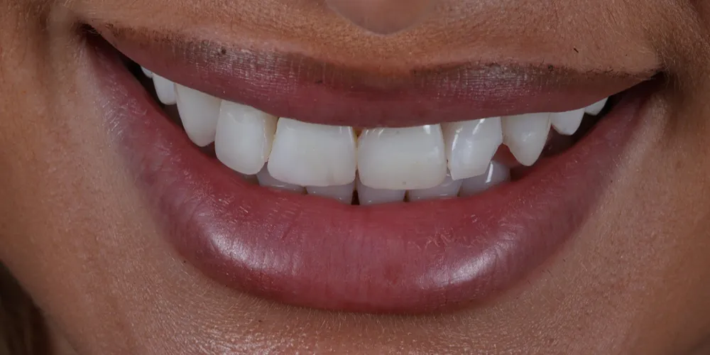 Before Composite Bonding
