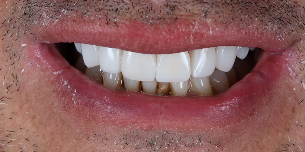After Composite Bonding