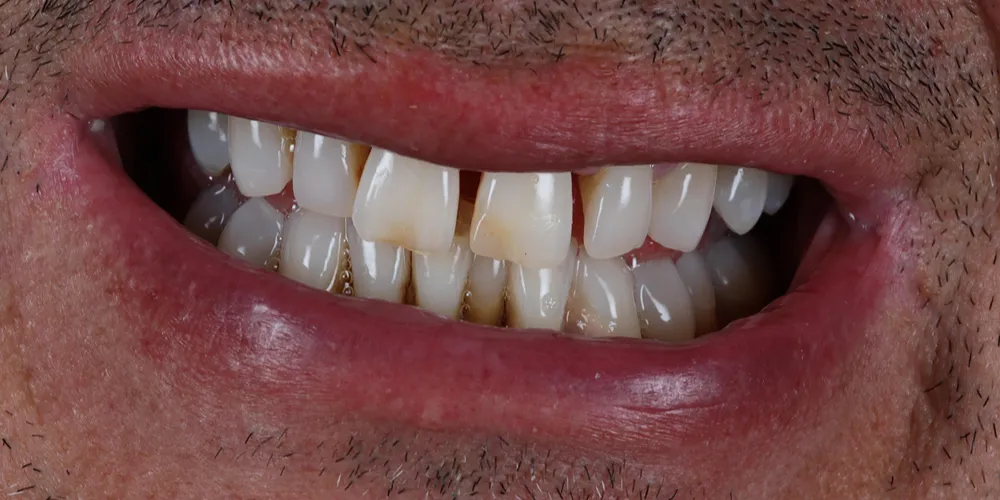 Before Composite Bonding