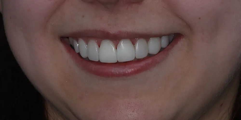 After Composite Bonding