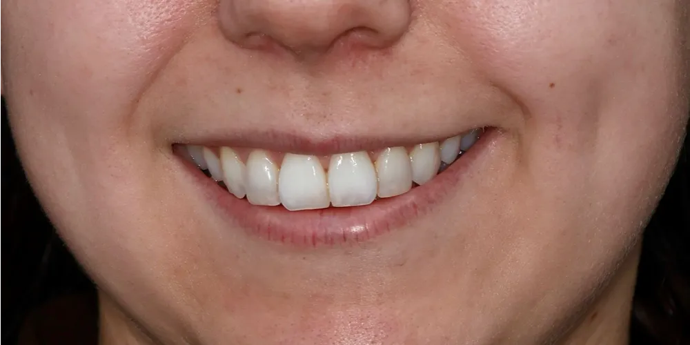 Before Composite Bonding
