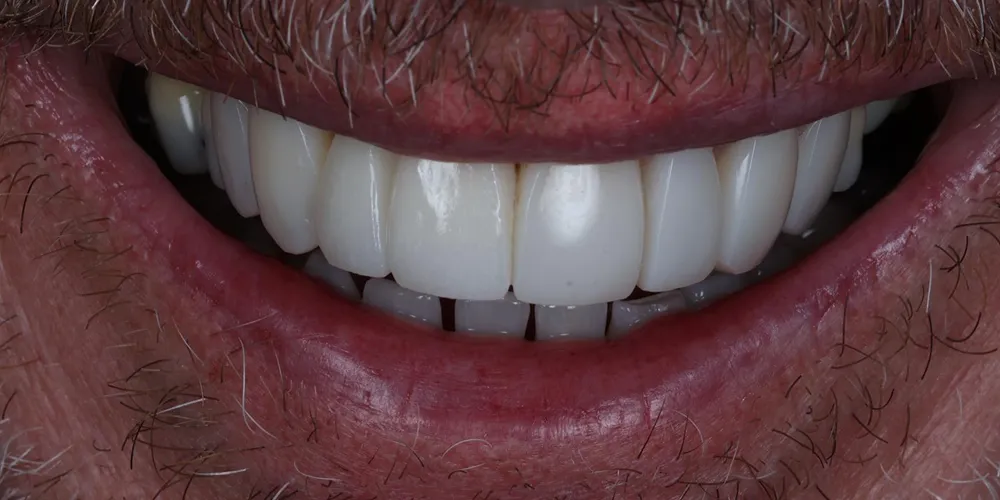 After Composite Bonding