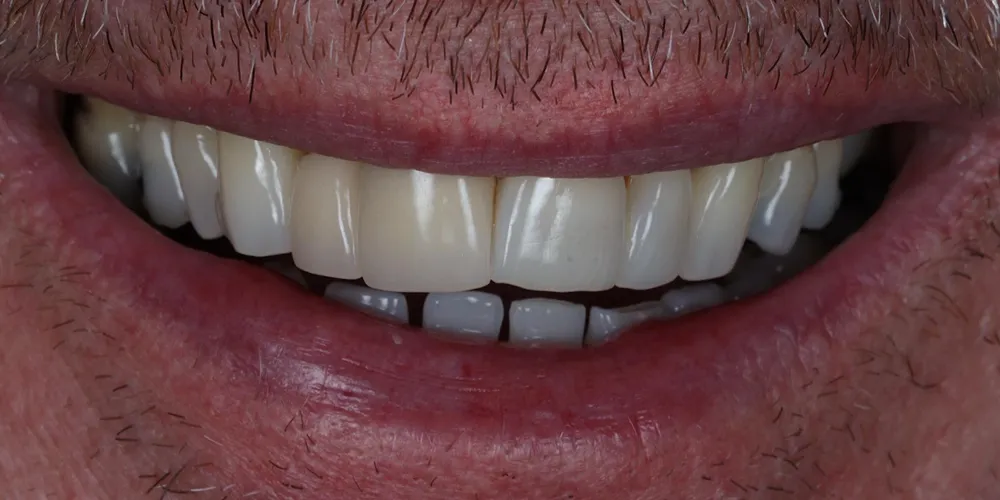 Before Composite Bonding