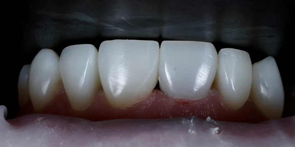 After Composite Bonding