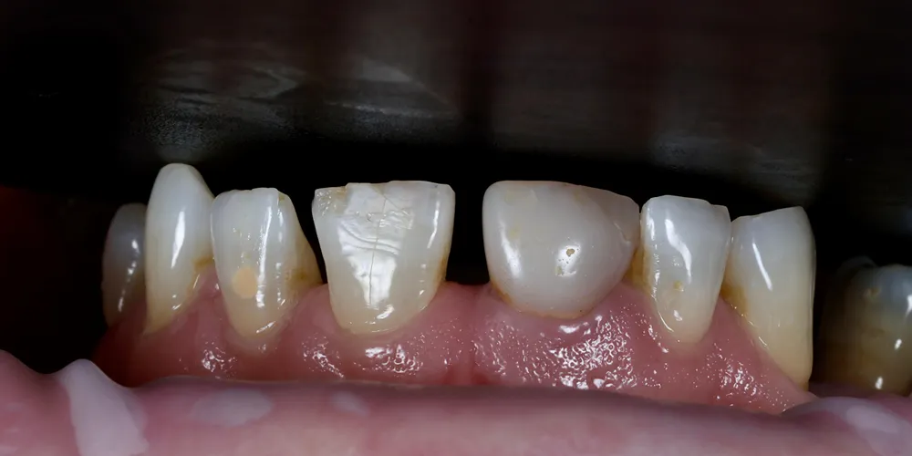 Before Composite Bonding