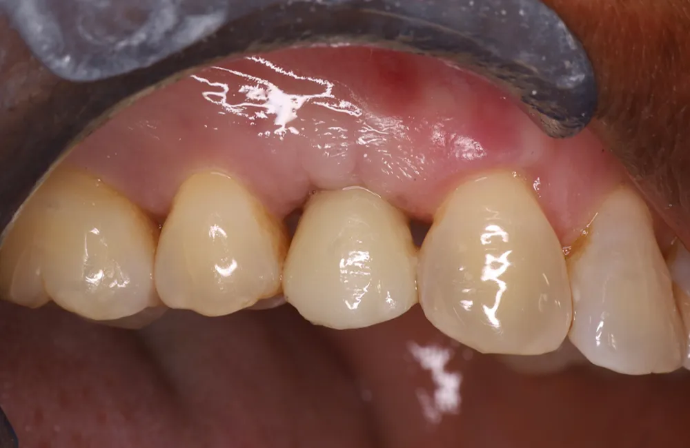 After implant