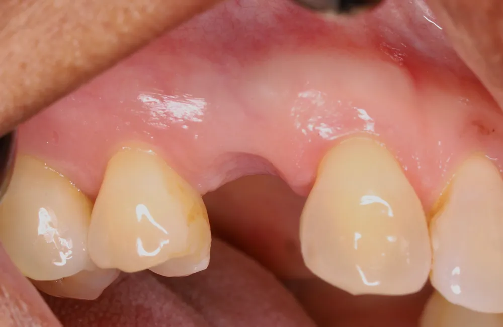 Before implant