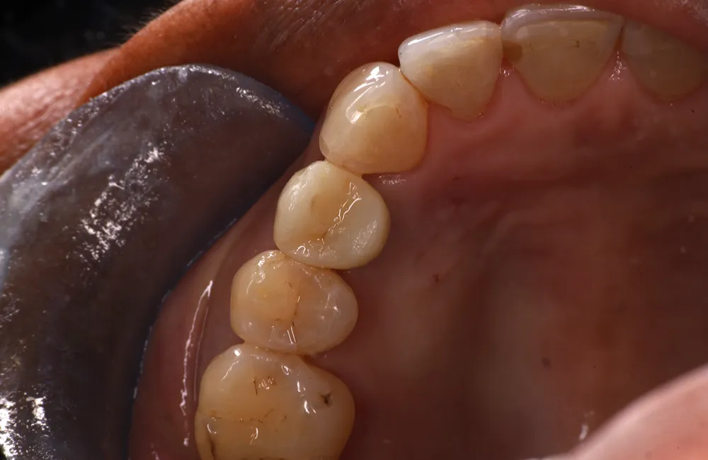After implant