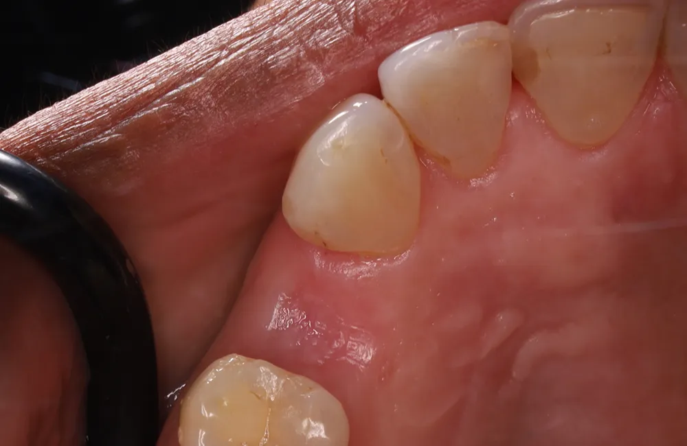 Before implant
