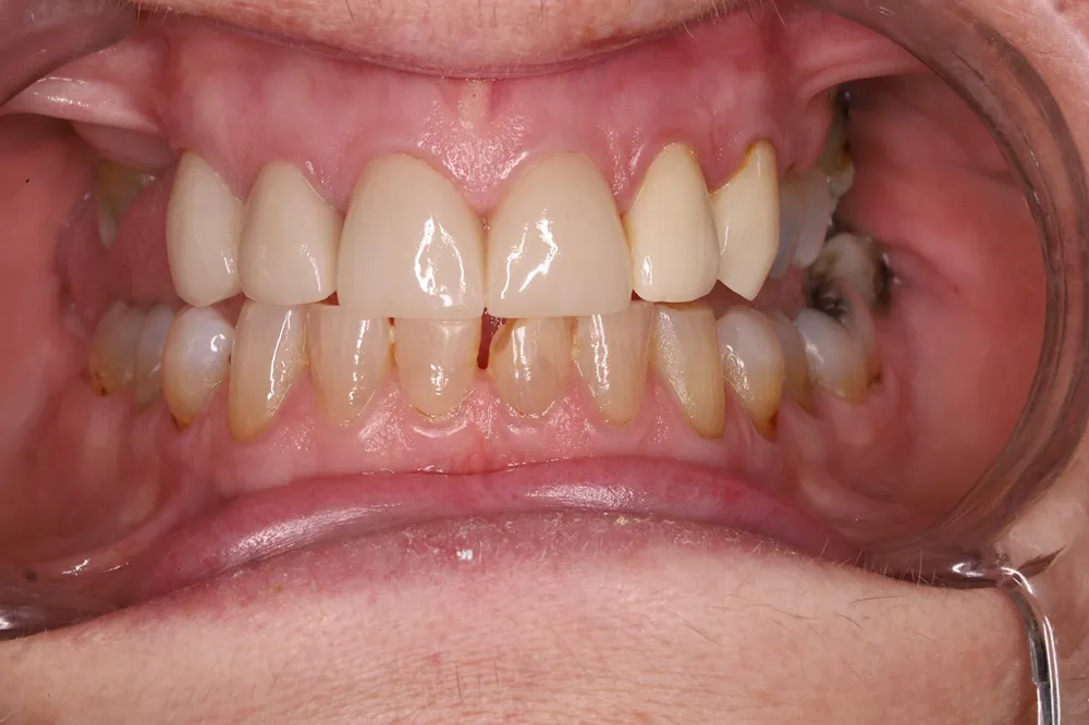 After porcelain veneers