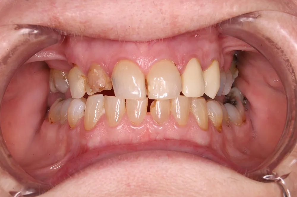 Before porcelain veneers