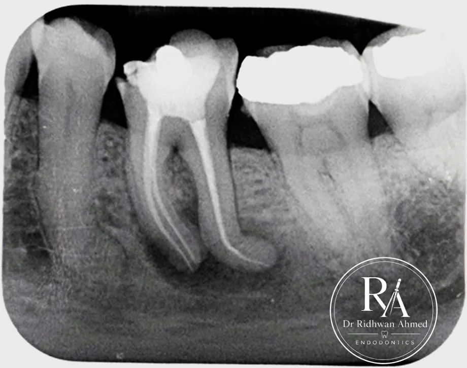 After root canal