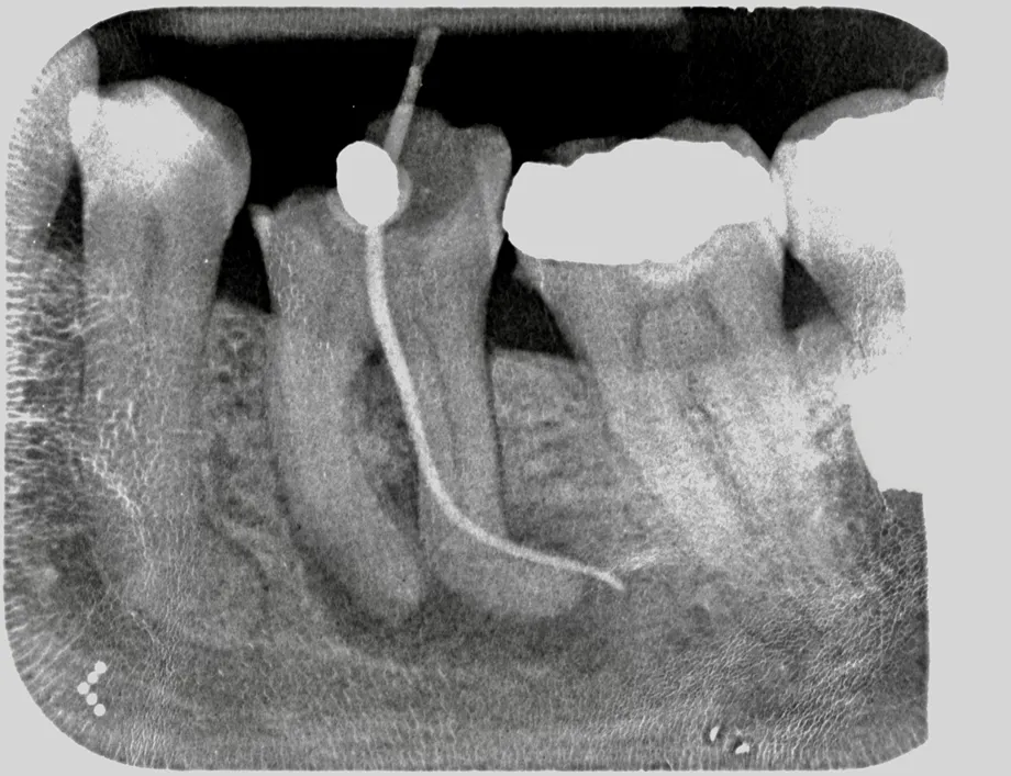 Before Root Canal