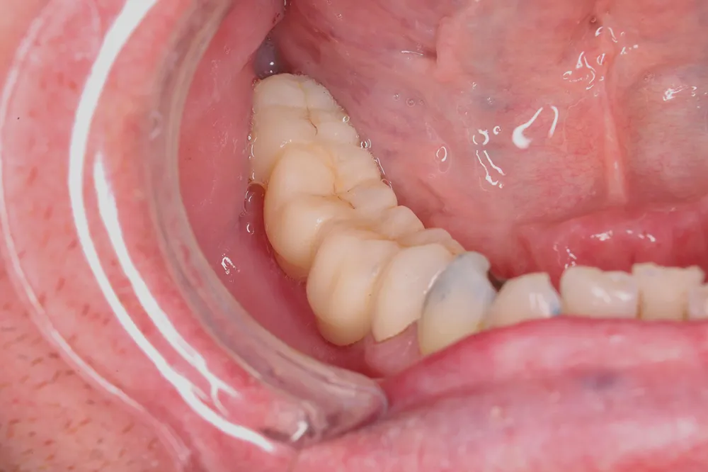 After Zirconia bridge