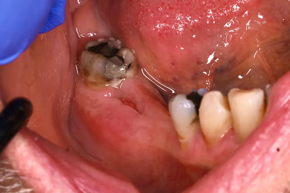 Before Zirconia bridge